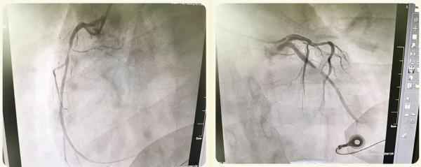 西青医院心内科团队紧张施救使一名30岁突发急性心肌梗塞患者挽回生命